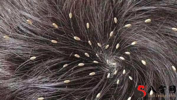 梦见头上有很多虱子